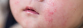 Bioptron Light Therapy for Eczema: How It Differs From UV Phototherapy and Everyday Skin Care