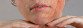 Rosacea-Prone Skin and Light Therapy: What Matters Before You Choose a Home Device