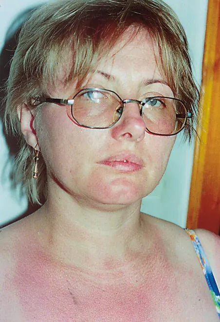 Acne Rosacea: Before and After