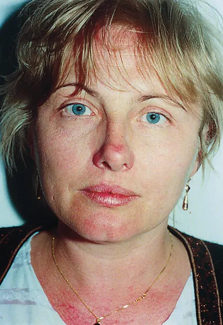 Acne Rosacea: Before and After