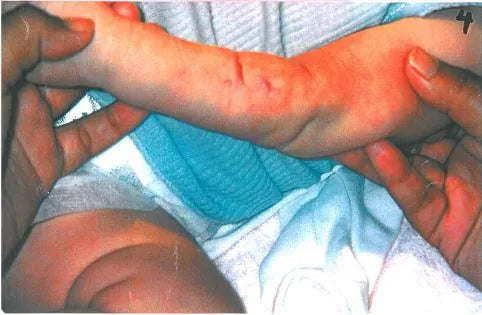 Baby Arm Ischaemia and Necrosis