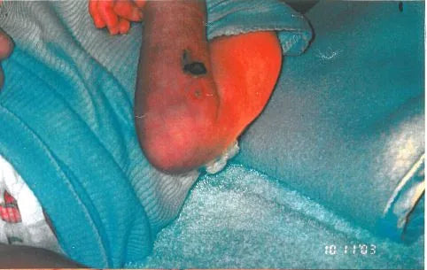 Baby Arm Ischaemia and Necrosis