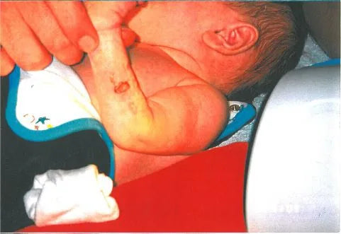 Baby Arm Ischaemia and Necrosis