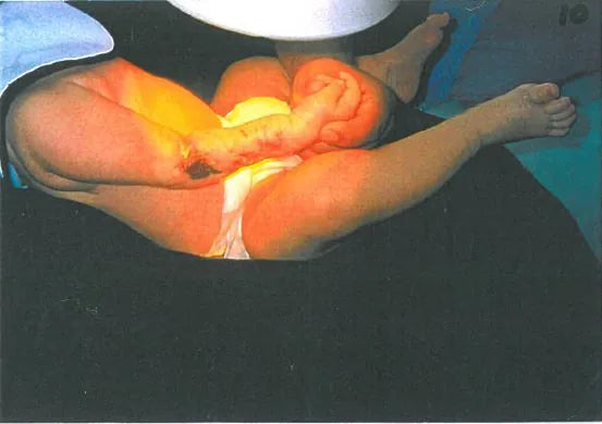Baby Arm Ischaemia and Necrosis