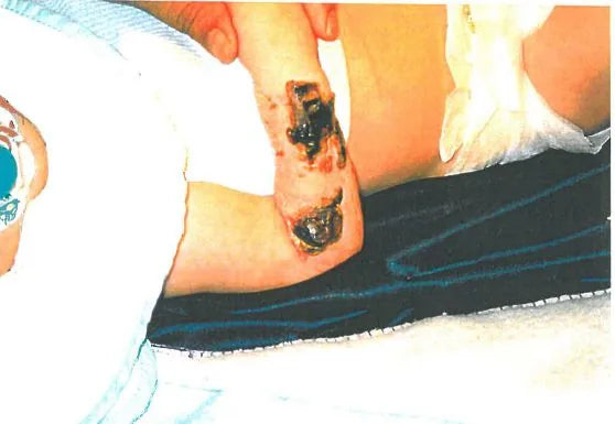 Baby Arm Ischaemia and Necrosis