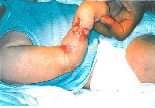 Baby Arm Ischaemia and Necrosis