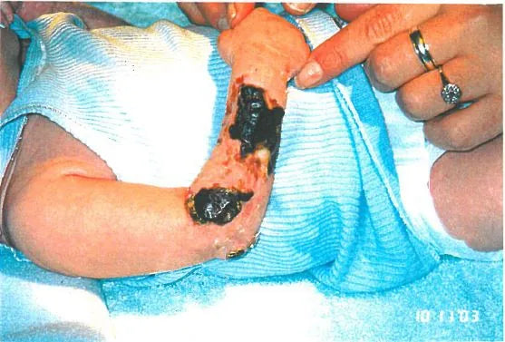 Baby Arm Ischaemia and Necrosis