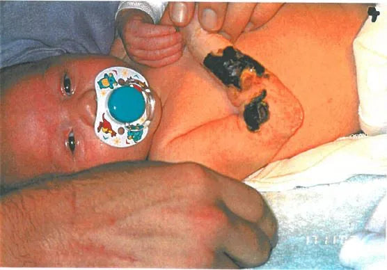 Baby Arm Ischaemia and Necrosis