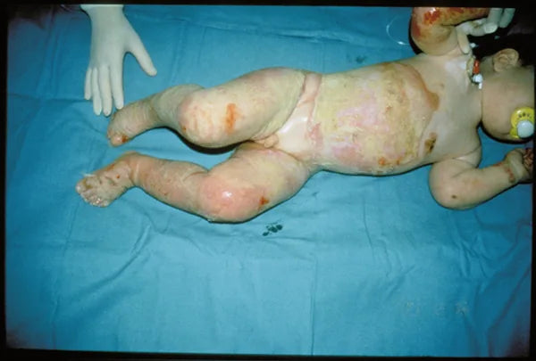 Baby Hot Water Burn: 12-Month Follow-Up