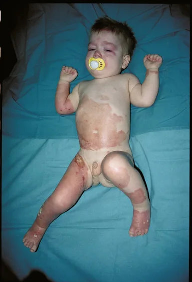 Baby Hot Water Burn: 12-Month Follow-Up