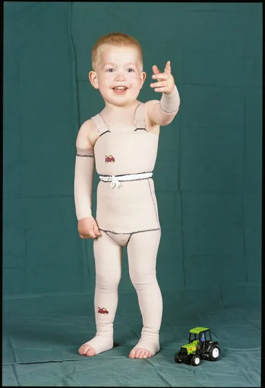 Baby Hot Water Burn: 12-Month Follow-Up