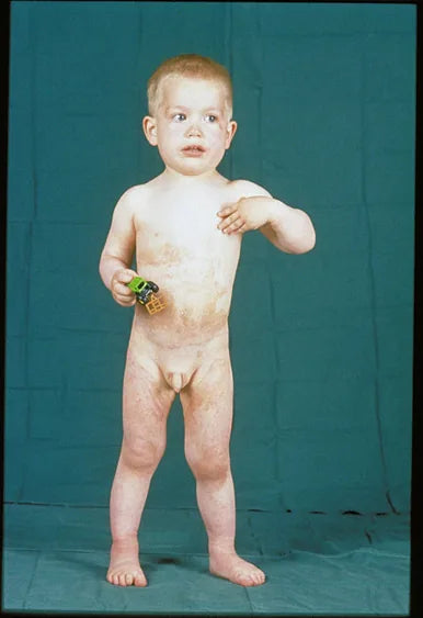 Baby Hot Water Burn: 12-Month Follow-Up