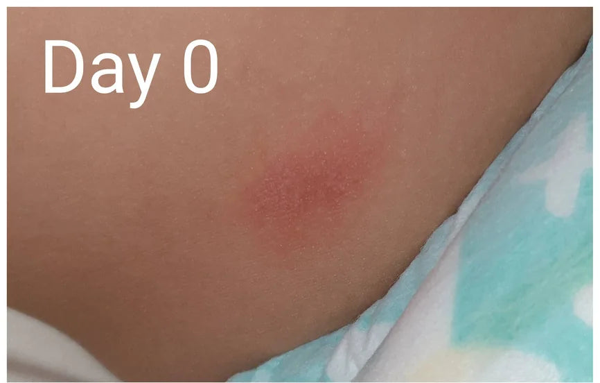 Baby Leg Eczema: Day 0 to Day 7