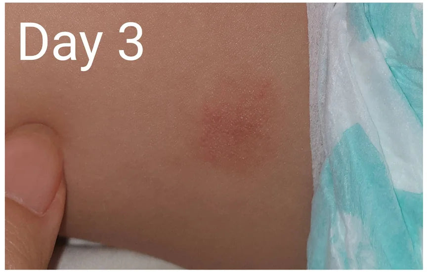 Baby Leg Eczema: Day 0 to Day 7