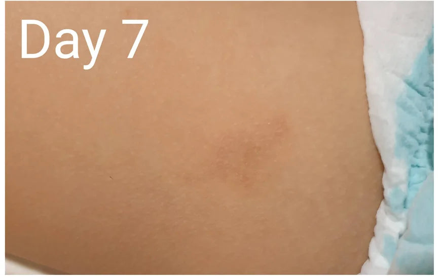 Baby Leg Eczema: Day 0 to Day 7
