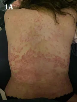 Back Psoriasis: 17-Day Photo Series