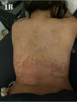 Back Psoriasis: 17-Day Photo Series