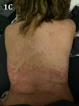 Back Psoriasis: 17-Day Photo Series