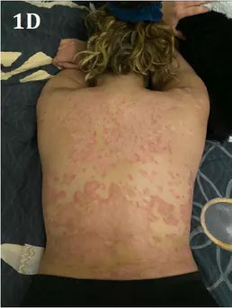 Back Psoriasis: 17-Day Photo Series