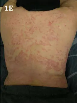 Back Psoriasis: 17-Day Photo Series