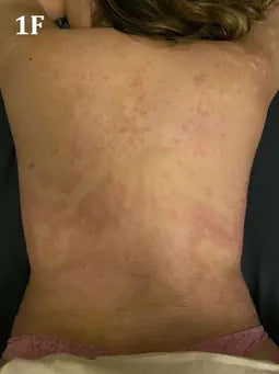 Back Psoriasis: 17-Day Photo Series