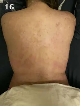 Back Psoriasis: 17-Day Photo Series