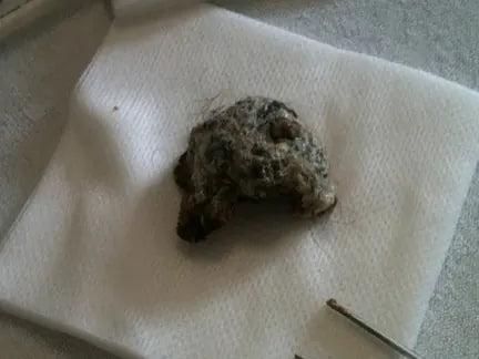 Fast-Growing Basalioma: 12-Week Photo Series