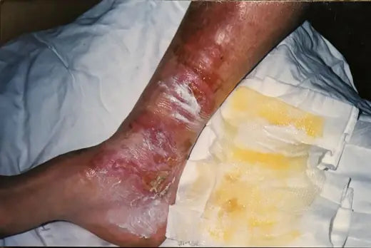 Bev’s Hot Water Leg Burn