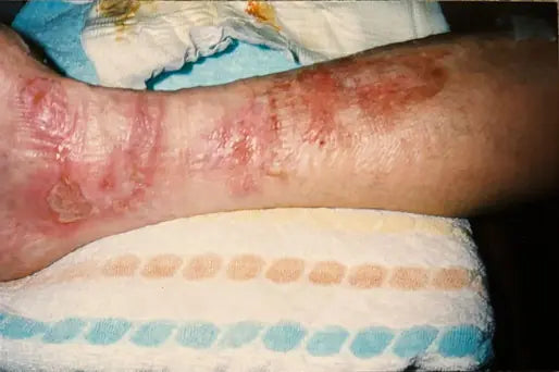 Bev’s Hot Water Leg Burn
