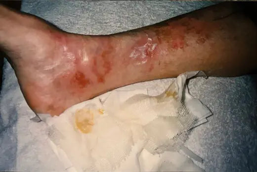 Bev’s Hot Water Leg Burn