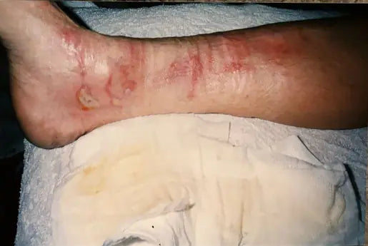 Bev’s Hot Water Leg Burn