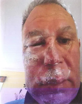 Facial Injury After Bike Fall