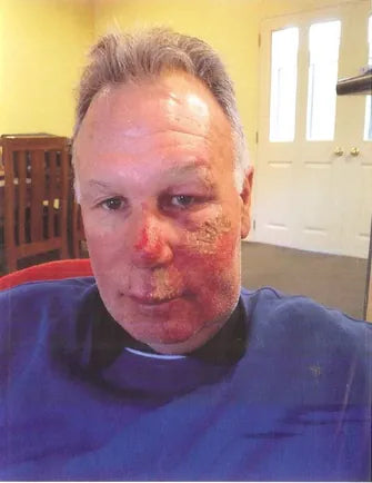Facial Injury After Bike Fall