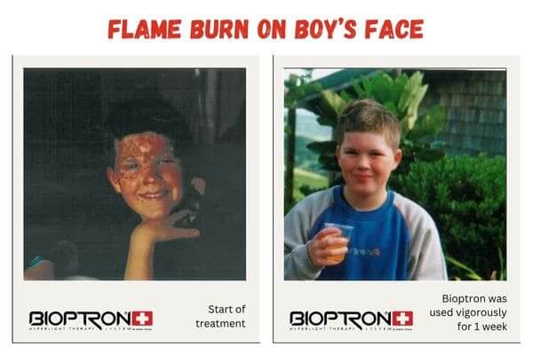 Bioptron light therapy device used near a healing wound for recovery support