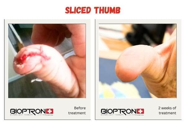 Bioptron light therapy device used near a healing wound for recovery support