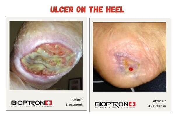 Bioptron light therapy device used near a healing wound for recovery support