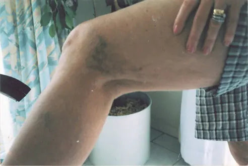 Bruise: 2-Month Photo Comparison