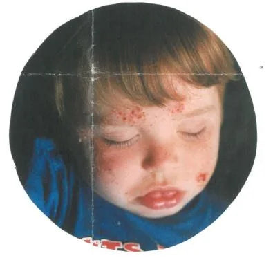 Child Facial Eczema: 4 Treatments