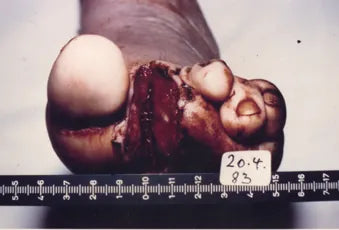 Diabetic Foot After Toe Amputation