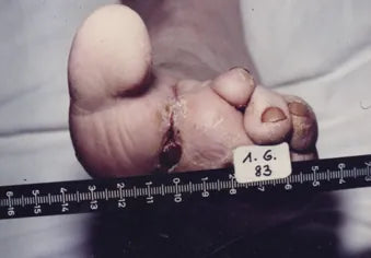 Diabetic Foot After Toe Amputation
