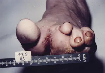 Diabetic Foot After Toe Amputation