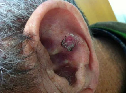 Basalioma of the Ear: Photo Sequence