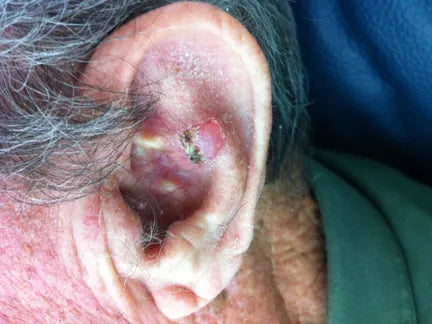 Basalioma of the Ear: Photo Sequence