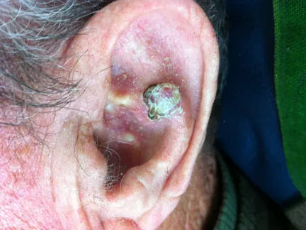Basalioma of the Ear: Photo Sequence