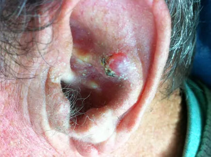 Basalioma of the Ear: Photo Sequence