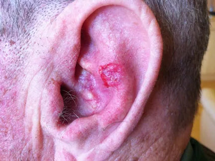 Basalioma of the Ear: Photo Sequence