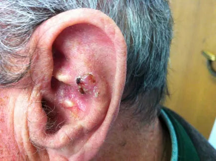 Basalioma of the Ear: Photo Sequence