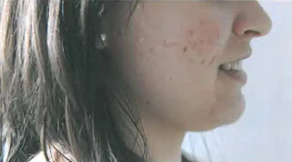 Facial Inflammation, Pimples and Dry Skin