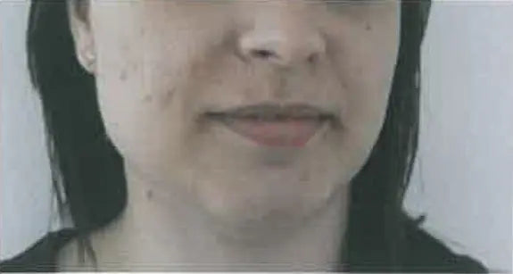 Facial Inflammation, Pimples and Dry Skin