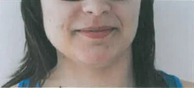 Facial Inflammation, Pimples and Dry Skin